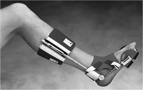 Dynamic Splinting For Contracture Reduction A Review The Foot And