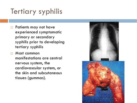 The Great Imitator In 2013 Syphilis And Hiv Infection