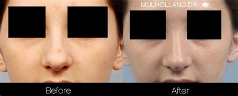 Rhinoplasty For Bulbous Nose Tip Causes And Treatment