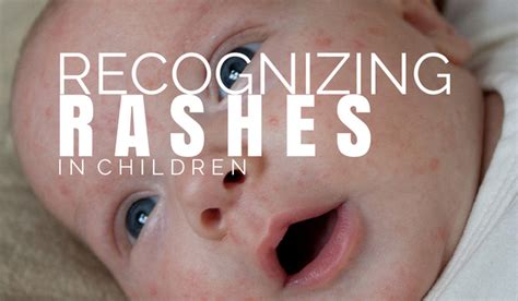 Recognizing Different Rashes In Children Quinte Pediatrics And