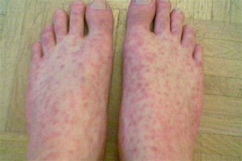 Types And Causes For Lupus Rash