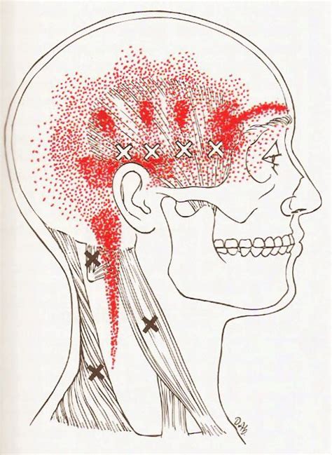 Trigger Point Pain Patterns Resulting From Trigger Points In The