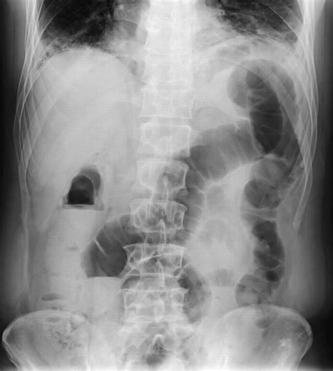 Acute Severe Constipation In A 58 Year Old Japanese Patient Gut