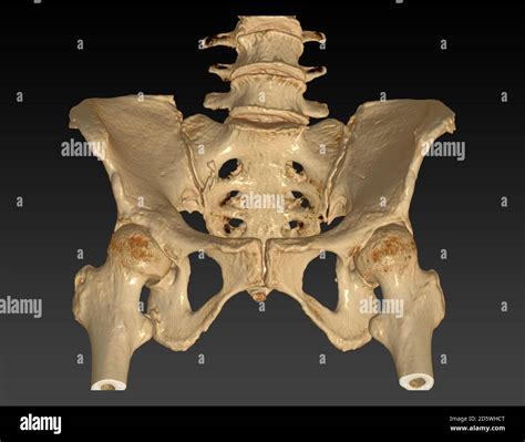 Pelvic Ct Hi Res Stock Photography And Images Alamy