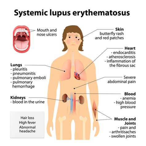 Medivisuals Systemic Lupus Erythematosus Sle Medical Illustration