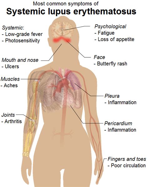 Systemic Lupus Erythematosus Case Study Physiopedia