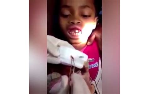 You Wont Believe This Video A Dentist Removes 15 Maggots From A 10 Year Old Girls Gums