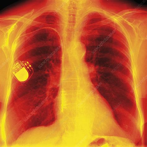 Heart Pacemaker X Ray Stock Image F0012984 Science Photo Library