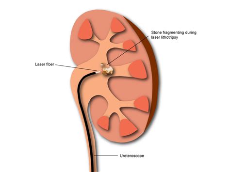 Percutaneous Nephrolithotomy For Kidney Stones Brighton And Sussex