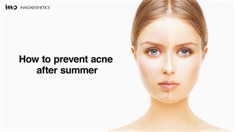 How To Prevent Acne After Summer Innoaesthetics