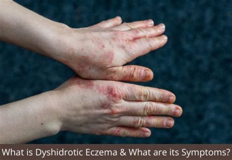 What Is Dyshidrotic Eczema And What Are Its Symptoms