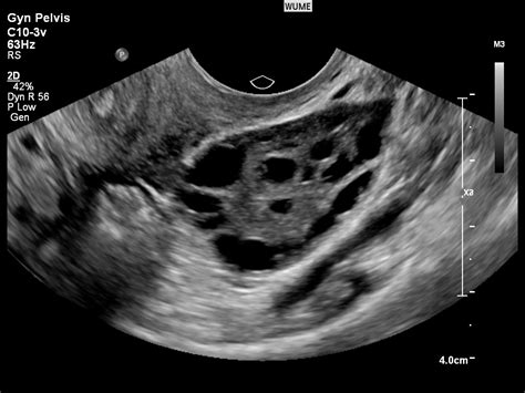 Carlo bulletti, maria elisabetta coccia, silvia battistoni. Gynaecology Ultrasound - Women's Ultrasound Melbourne