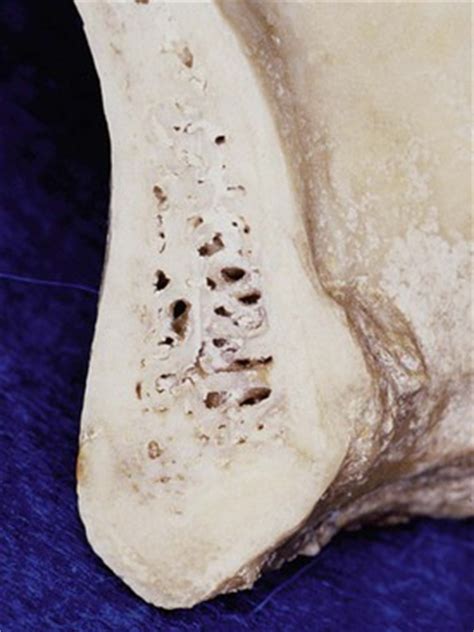 Bone structure right foot 12 photos of the bone structure right foot bone structure in. 11 Bone Density | Pocket Dentistry