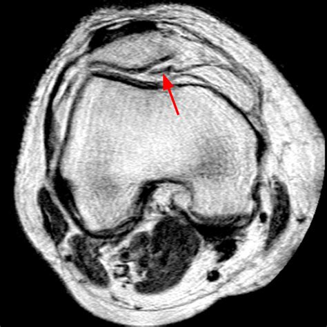 Synovial Plicae Of The Knee Radsource