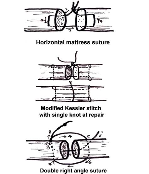 Line Diagram Showing Horizontal Mattress Modified Kessler And Double