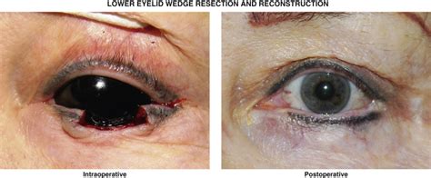 Lower Eyelid Wedge Resection And Reconstruction Plastic Surgery Key