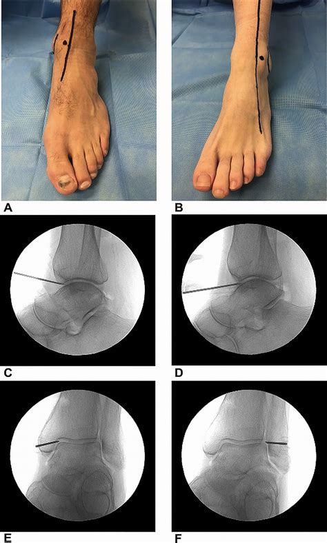 Septic Arthritis Of The Native Ankle Jbjs Reviews