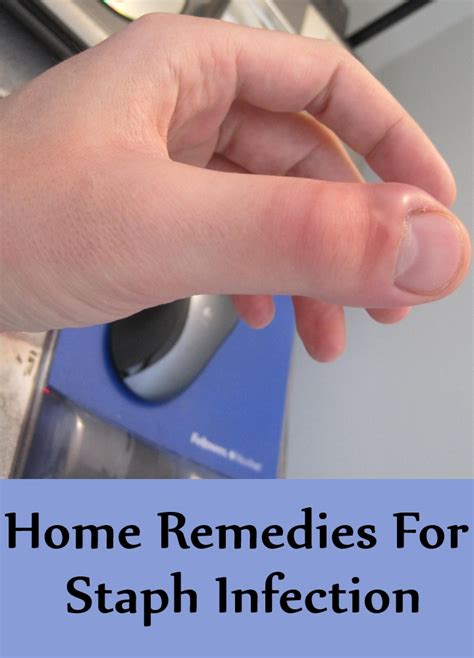 10 Home Remedies For Staph Infection Search Home Remedy