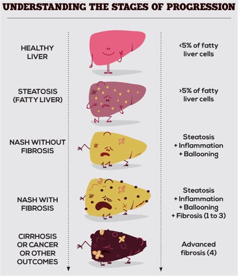 Fatty Liver Disease Symptoms Causes Risks And Treatme