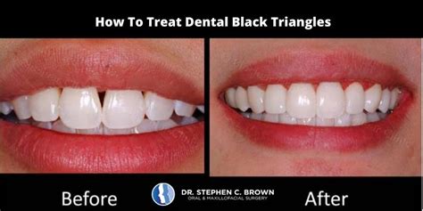 How To Treat Dental Black Triangles