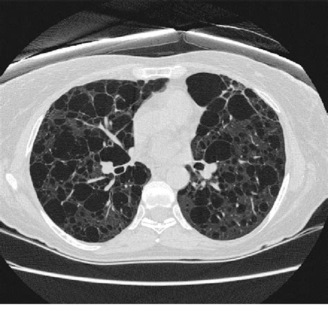 End Stage Cystic Lung Disease In A Woman With Tuberous Sclerosis