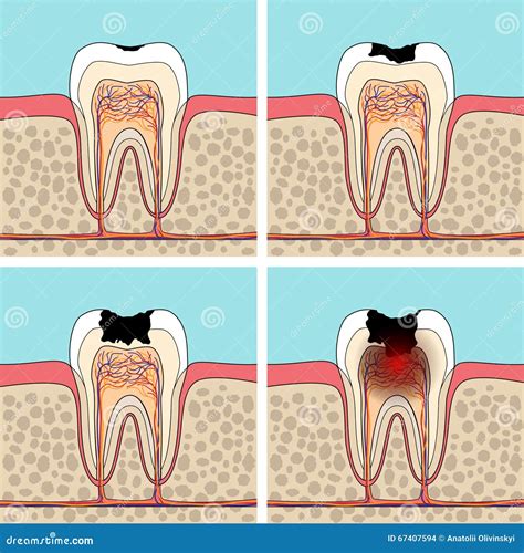 Fases da cárie dental ilustração do vetor Ilustração de lifestyle