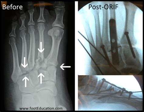 Lisfranc Fracture Orif Footeducation
