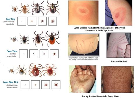 Lyme Disease Co Infections
