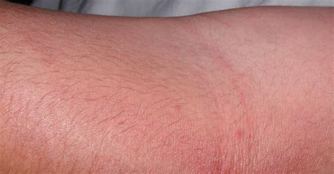 42 Frisch Bild Rash On Inner Arm Skin Rash 56 Pictures Causes And