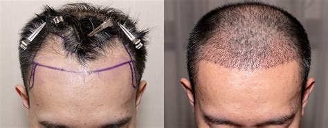 How Does Hair Transplant Work In Depth Guide By Crown Clinic