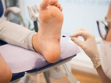 How To Safely Remove A Foot Wart At Home Foot And Ankle Group