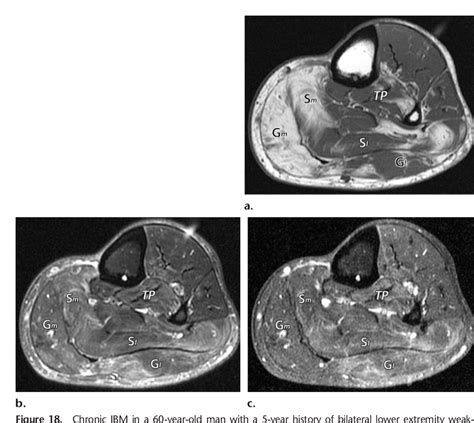 Figure 1 From Soft Tissue Infections And Their Imaging Mimics From