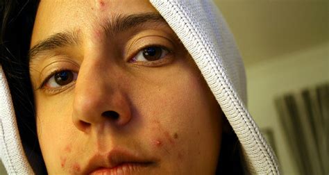 10 Most Easy Remedies For Pimples