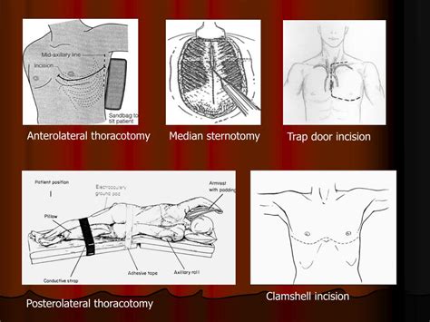 Ppt Surgery In Cardiothoracic Powerpoint Presentation Free Download