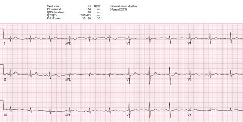 Posterior Wall MI ECG