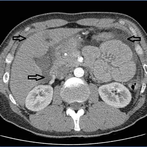 Abdominal Ct Scan Showing Distention Bundling And Thickening Of Some