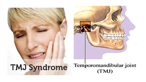Symptoms And Treatments For Temporomandibular Joint Disorders Rocky