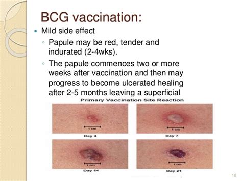 Though, these scars are mostly seen in people who are. Bcg and hep b vaccination