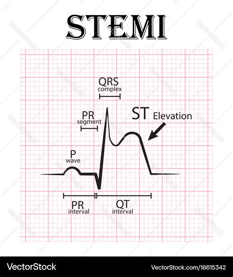 Ecg Of Non St Elevation Myocardial Infarction Vector Image On Images