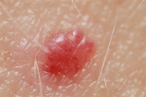 What Those Tiny Red Dots On Your Skin Might Mean Scary Symptoms