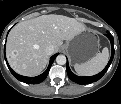 Metastatic Carcinoid Tumor To The Liver Liver Case Studies Ctisus