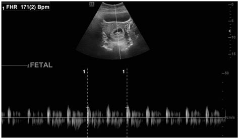 transvaginal pelvic ultrasound 1 week post laparoscopic salpingectomy download scientific