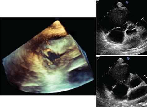 Transthoracic Echocardiography Of The Tricuspid Valve In The