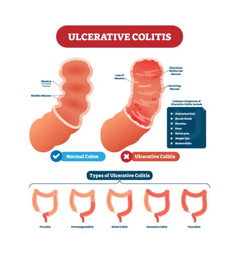 Ulcerative Colitis Treatment Dr Ong Paediatrician Gastroenterologist