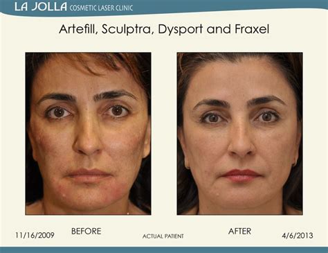 Patient Treated With Artefill Sculptra Dysport And Fraxel At La Jolla