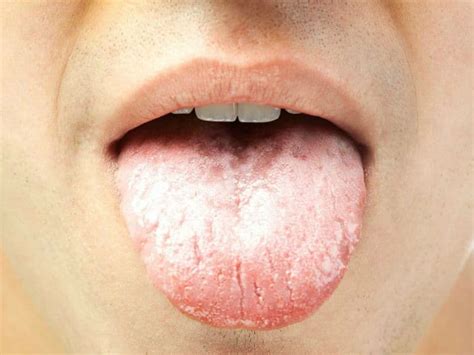 The great imitator strikes again: Reasons Why You Have a White Tongue + Remedies | StethNews