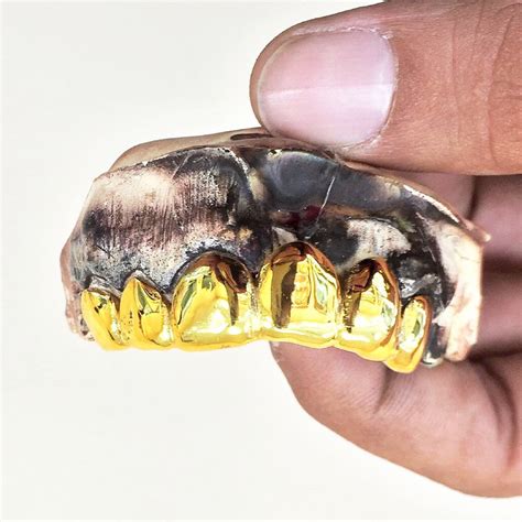 22k Permanent Gold Teeth Prices Ubicaciondepersonascdmxgobmx