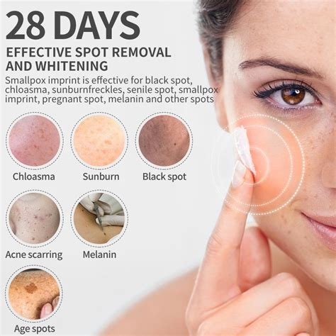 15 Best Freckle Removal Creams To Lighten Your Skin 2022 Whitening Freckle Cream Removal