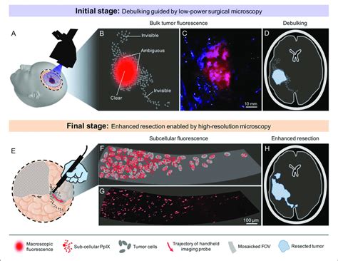 Proposed Clinical Workflow Of 5 Ala Based Fluorescence Guided