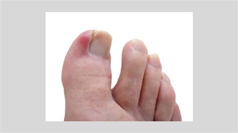 Ingrown Toenails Causes Symptoms And Diagnosis